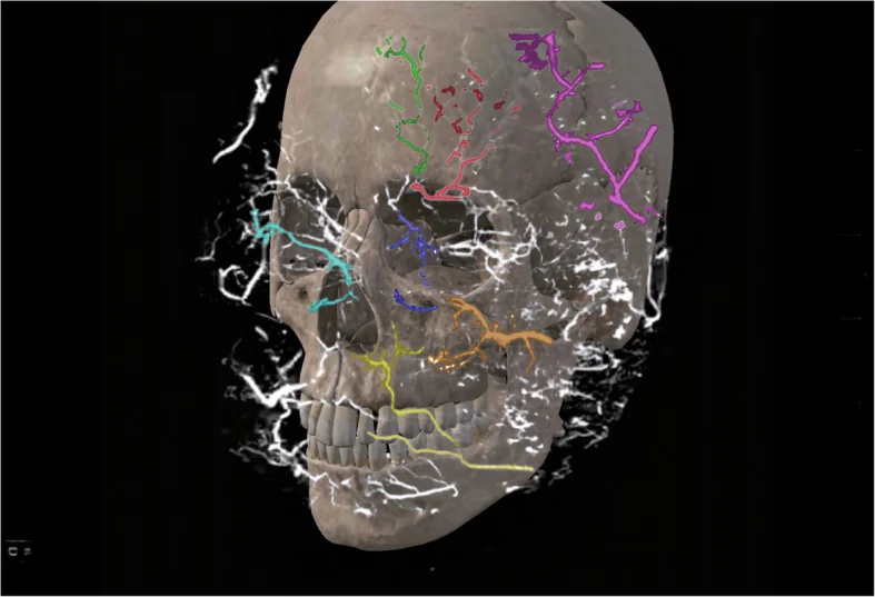 Three-dimensional reconstruction of the facial and ocular arteries colour-coded over the skull.