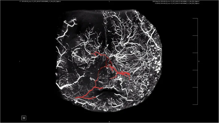 Anastomosis between a facial artery branch and the dorsal nasal artery, a branch of the ophthalmic.