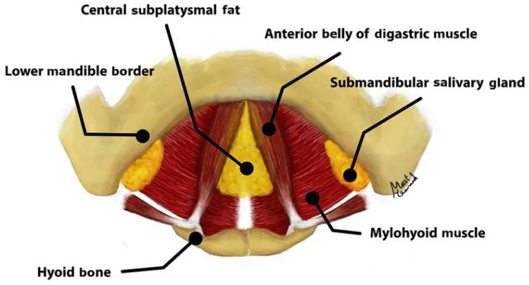 Schematic of the subplatysmal structures: central fat, anterior digastric bellies, submandibular glands and hyoid.