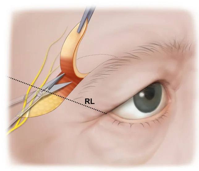 Esquema de la browplastia temporal directa mostrando el plano de disección subcutáneo.