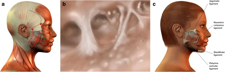 The retaining ligaments over the face: orbicularis retaining, zygomatic, masseteric cutaneous, mandibular and platysma-auricular. Aligned, they describe the line running from the lateral canthus to the mandibular angle.