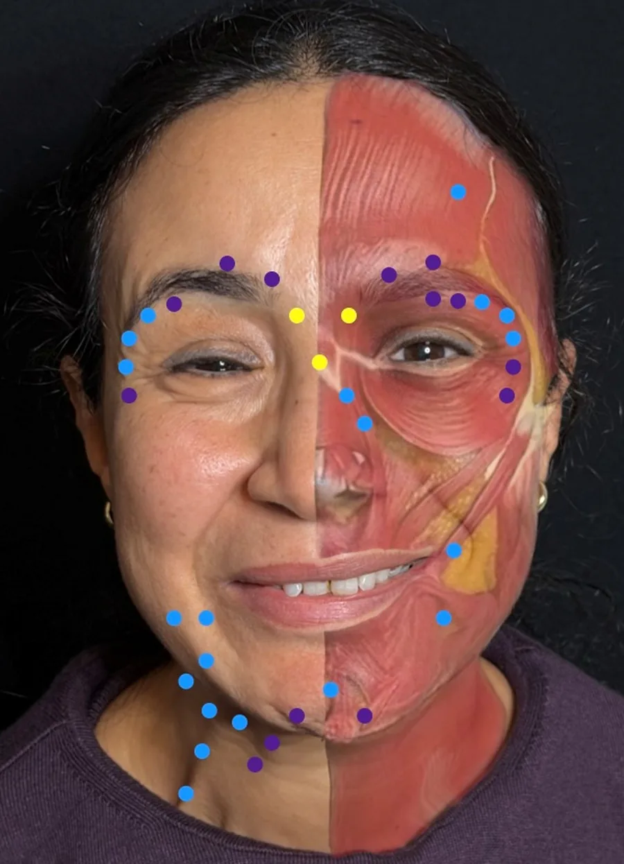 Second injection point map, in a patient with recurrent facial palsy and chronic synkinesis.