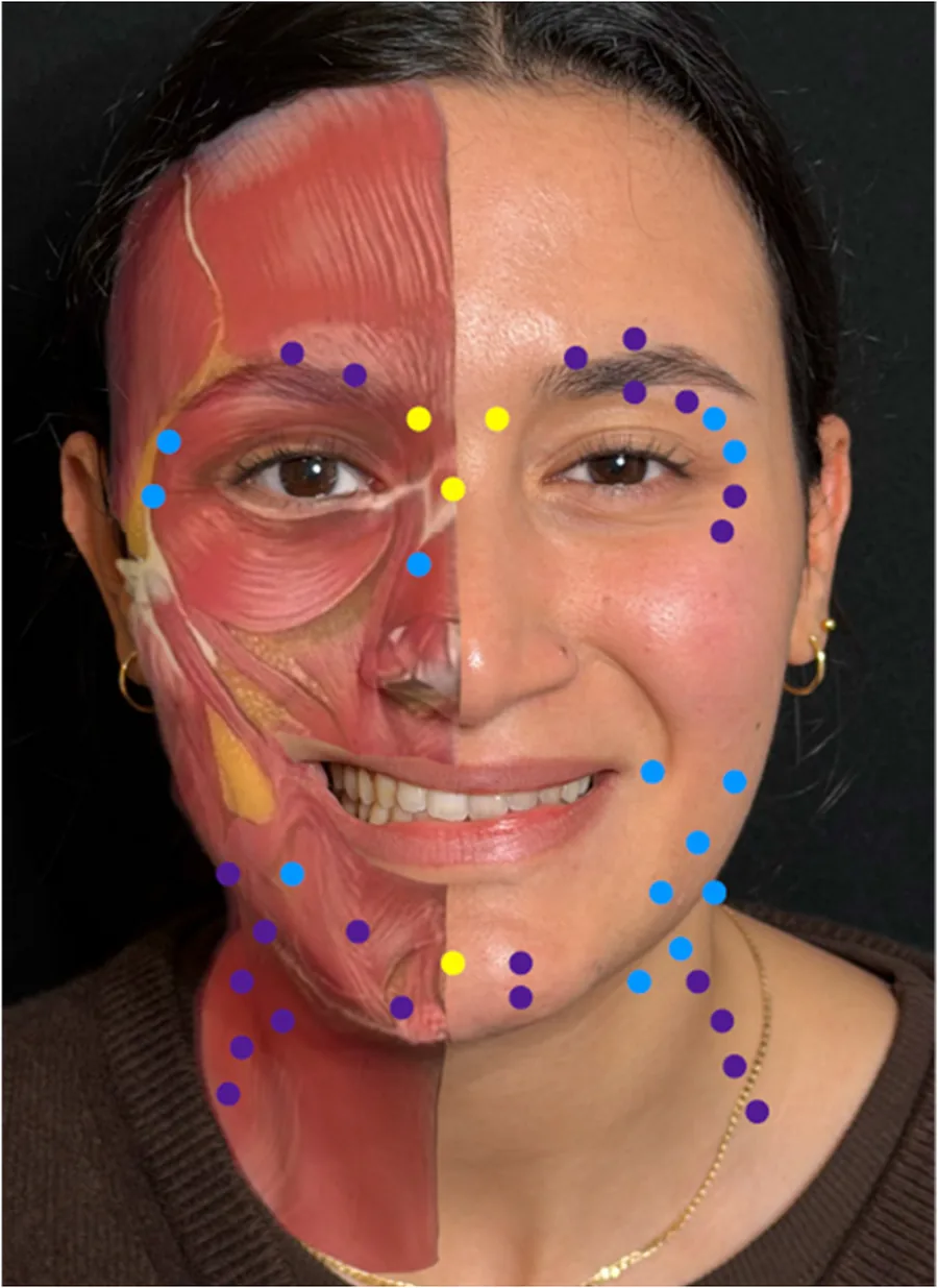 Botulinum toxin injection point map over a face with muscular anatomy superimposed on the left hemiface.