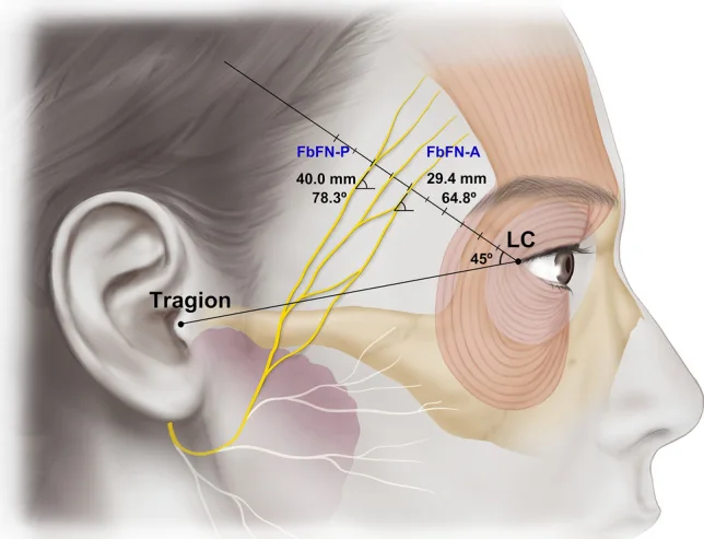 Trayecto de la rama frontal del nervio facial con las referencias del tragión y el canto lateral.