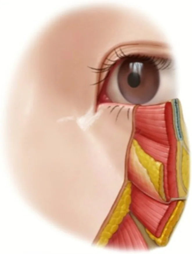 Esquema de las fibras del surco lagrimal insertándose verticalmente en la dermis nasoyugal.